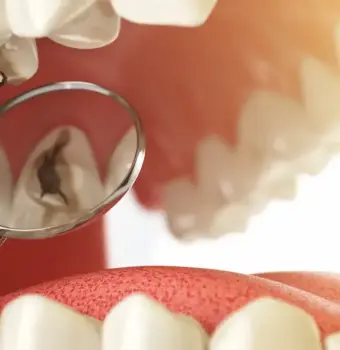 Caries dentales: cómo prevenirlas y mantener tus dientes sanos