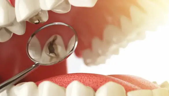 Caries dentales: cómo prevenirlas y mantener tus dientes sanos