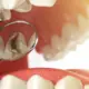 Caries dentales: cómo prevenirlas y mantener tus dientes sanos
