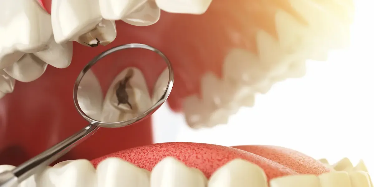 Caries dentales: cómo prevenirlas y mantener tus dientes sanos