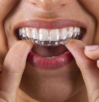 Ortodoncia invisible: alinea tu sonrisa de forma cómoda y discreta
