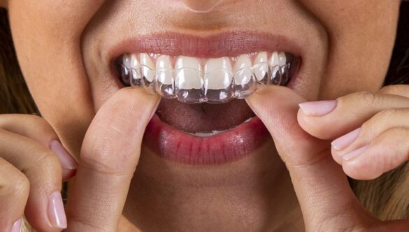 Ortodoncia invisible: alinea tu sonrisa de forma cómoda y discreta