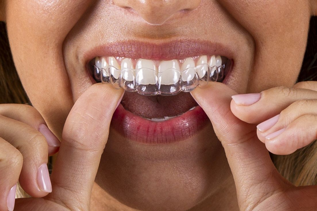 Ortodoncia invisible: alinea tu sonrisa de forma cómoda y discreta